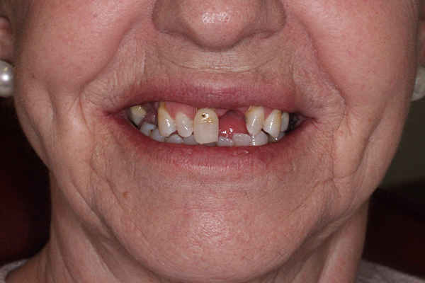 Clínica Antequera y Cerón - Antes despues Caso 4 - Antes