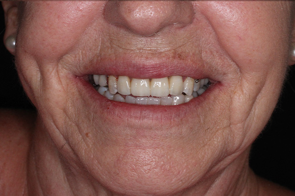 Clínica Antequera y Cerón - Antes despues Caso 4 - Despues